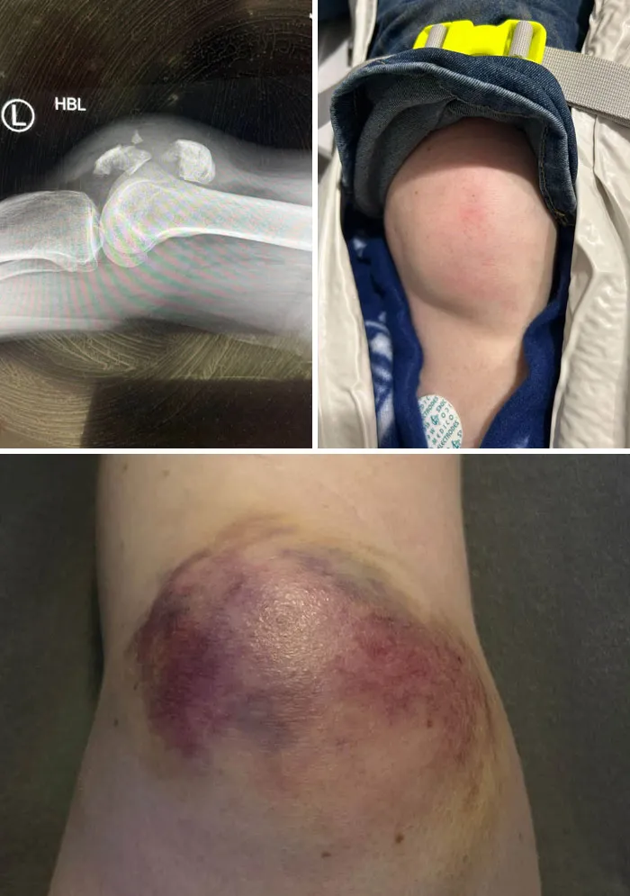 Medical photos showing a fractured knee X-ray, swollen kneecap, and severe bruising.