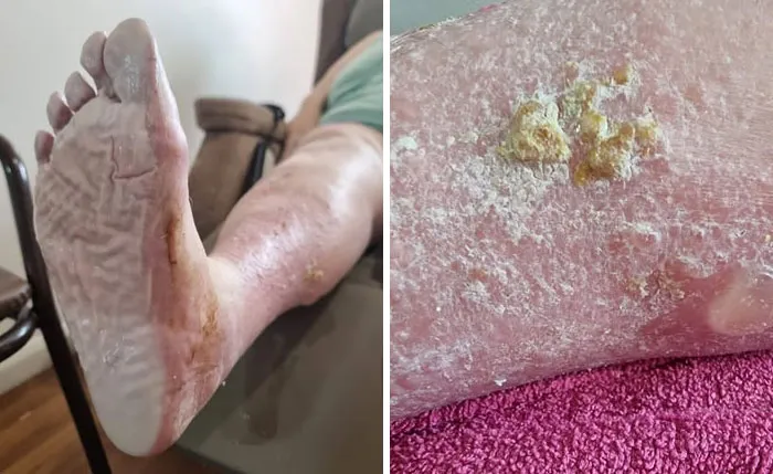 Disturbing medical photo showing a peeling foot and severe skin condition on a leg.