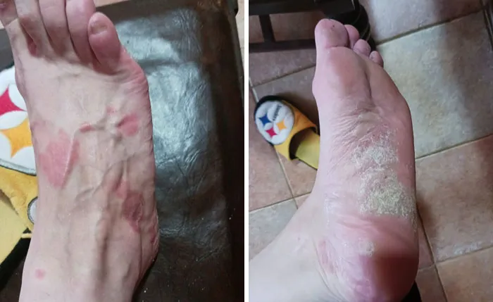 Medical photos showing top and bottom views of a foot with a severe skin rash.