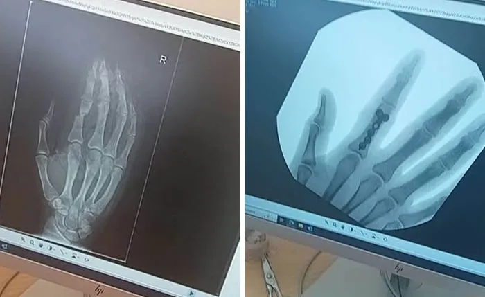 Medical photos displaying hand X-rays before and after surgical bone repair with plates