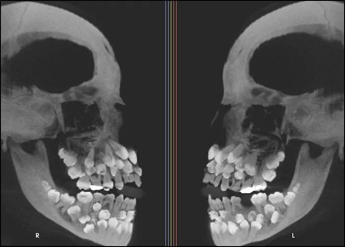 A medical scan of a skull with hyperdontia showing multiple extra teeth, a highlight of interesting and cool pics