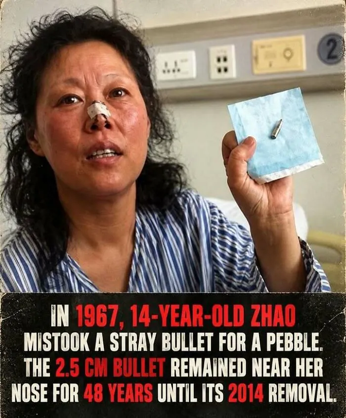 Zhao had bullet near her nose for 48 years before removal in 2014