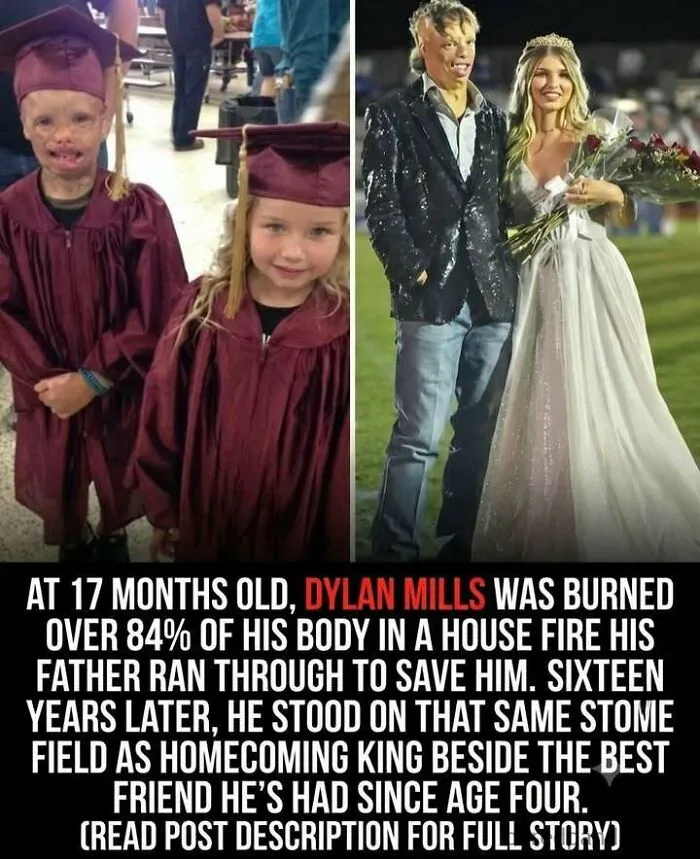 Dylan Mills burned over 84 percent of body, crowned homecoming king with childhood best friend