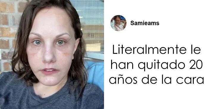 Los resultados del lifting facial que se hizo esta mujer por 15000$ han alucinado a todo internet