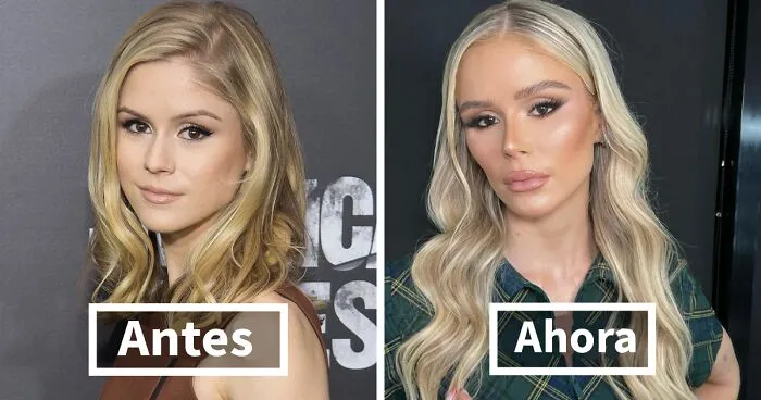 17 Celebridades que quedaron irreconocibles tras su cirugía plástica