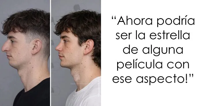 25 Personas que se ven irreconocibles tras su cirugía plástica