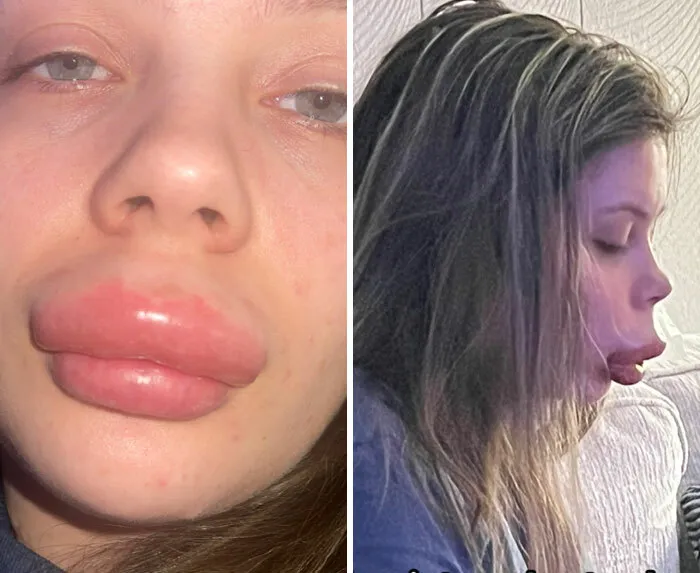 Mujer con labios extremadamente hinchados tras salir disgustada de un salon de belleza