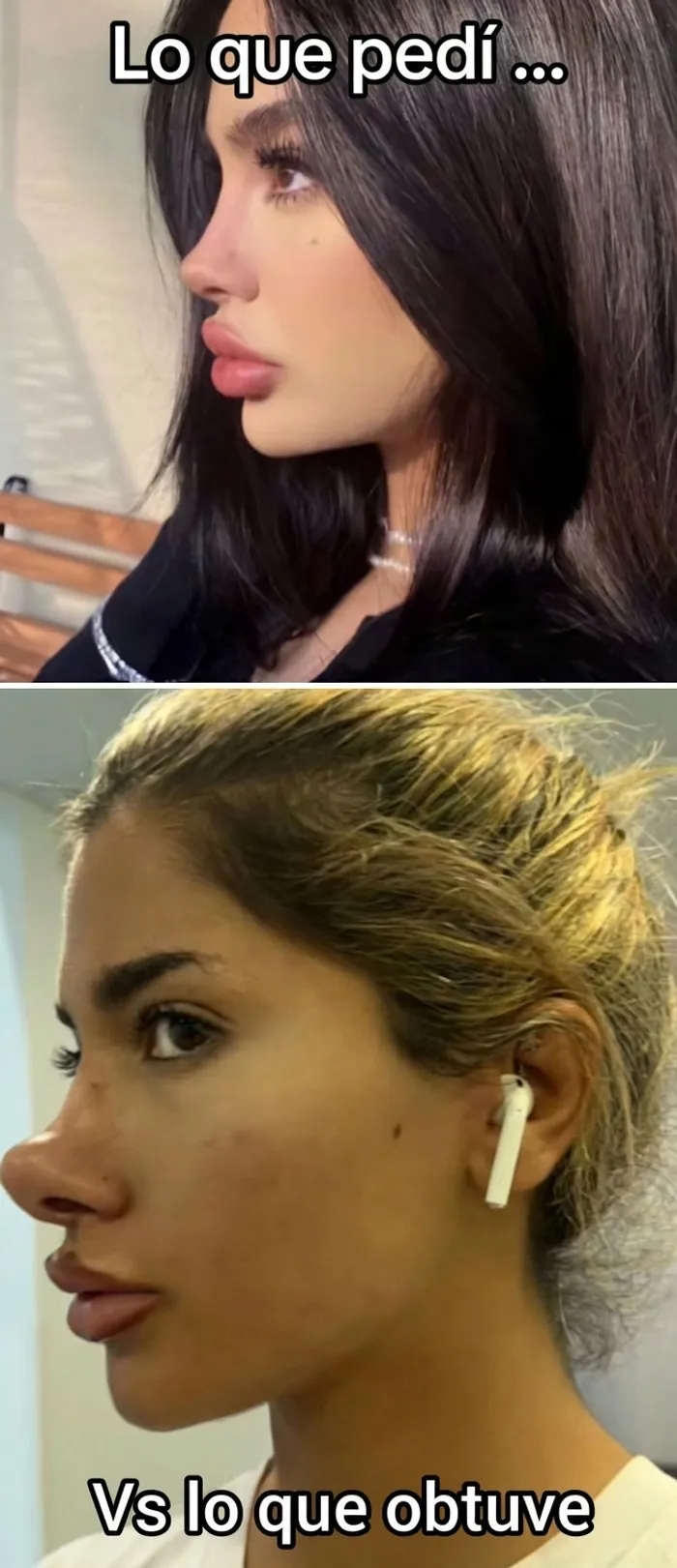 Comparativa de expectativa y realidad de una rinoplastia fallida hecha en un salon de belleza