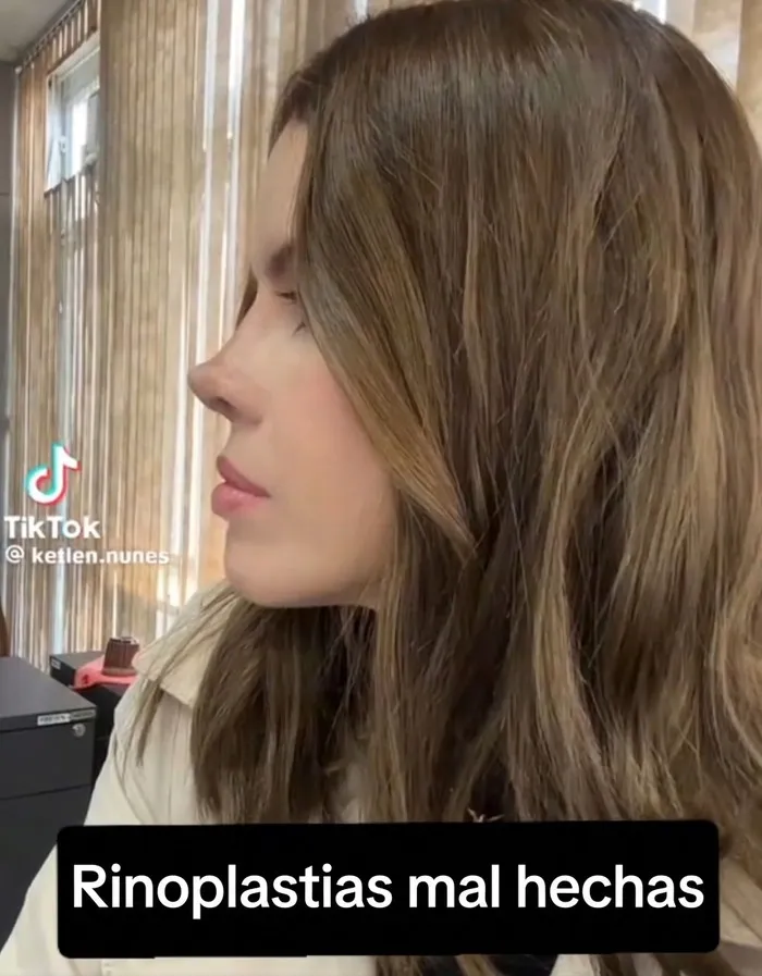 Resultado de rinoplastia de una mujer descontenta que visito un salon de belleza