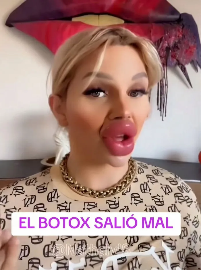 Mujer con labios sumamente hinchados tras ir al salon de belleza