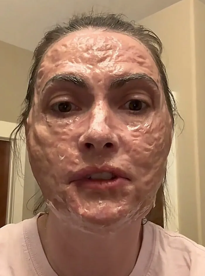 Rostro de mujer con reaccion alergica severa por un procedimiento en el salon de belleza