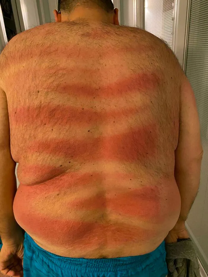 Hombre con quemaduras de sol con rayas en la espalda hechas por novias y esposas