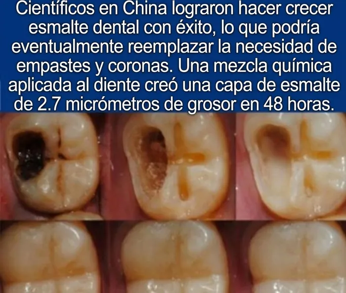 Imágenes de dientes mostrando restauración de esmalte dental en datos curiosos de medicina
