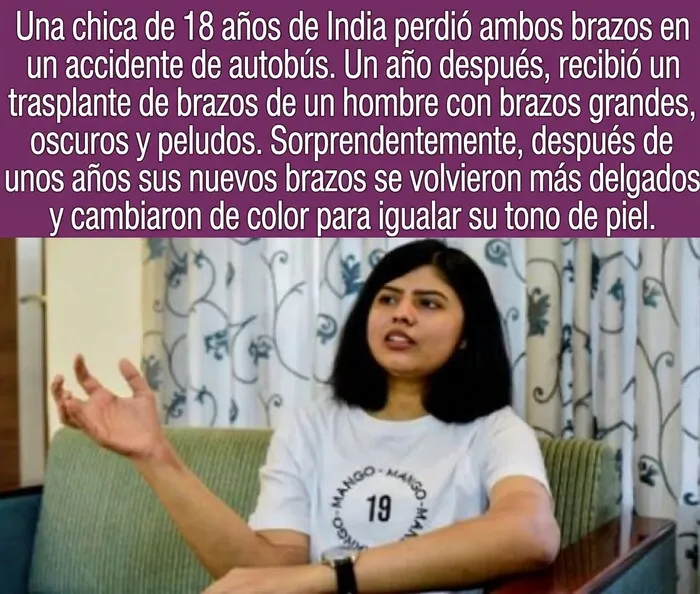 Datos curiosos: Una joven de la India muestra sus brazos trasplantados que cambiaron de tono de piel.