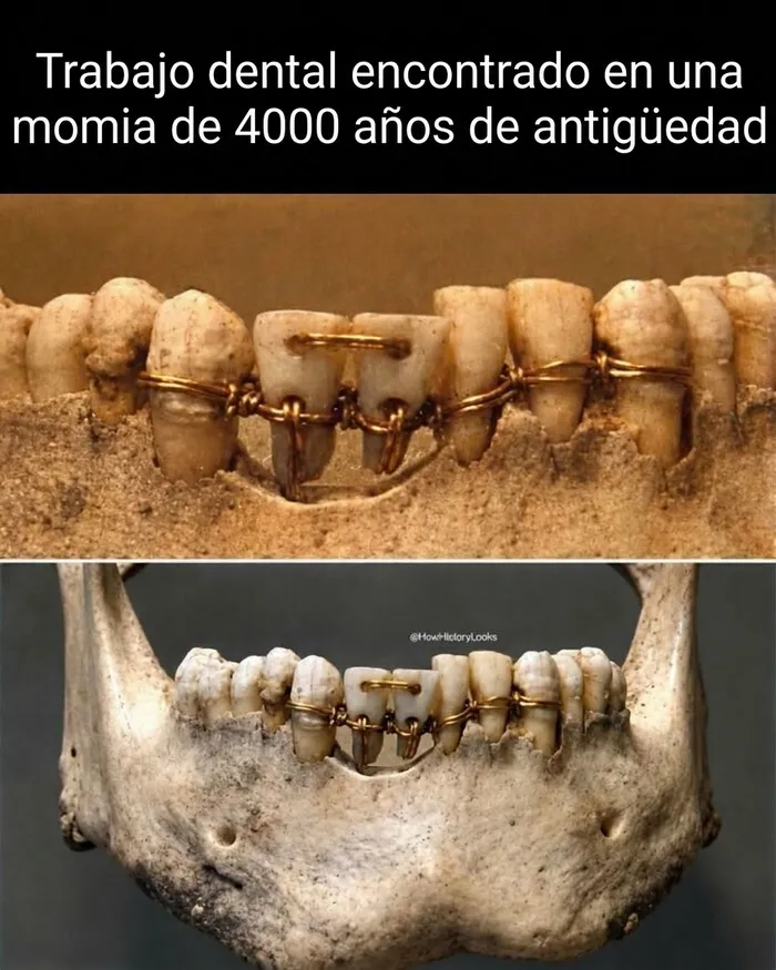 Dentadura antigua de una momia egipcia, ejemplo de fotos históricas y datos curiosos sobre la medicina.