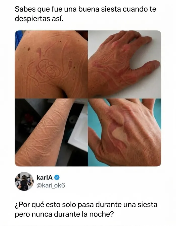 Marcas en la piel tras dormir una siesta en un meme divertido sin contexto.