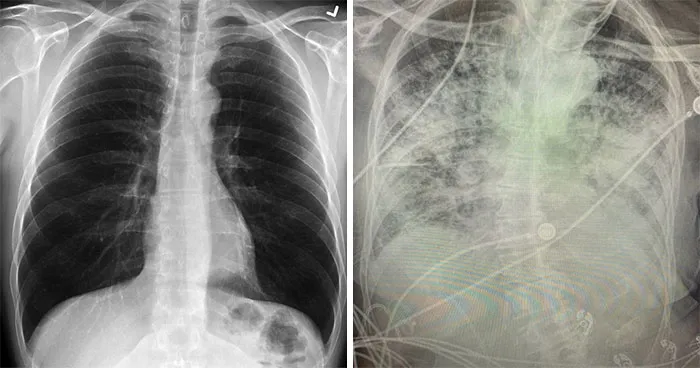 Unas radiografías muestran los efectos del COVID-19 en los pulmones comparados con los de un fumador