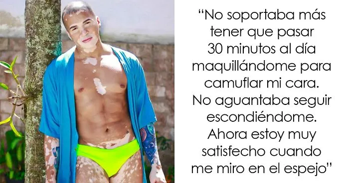 De la sombra a la luz: Este brasileño dejó de ocultar su vitiligo para triunfar como modelo