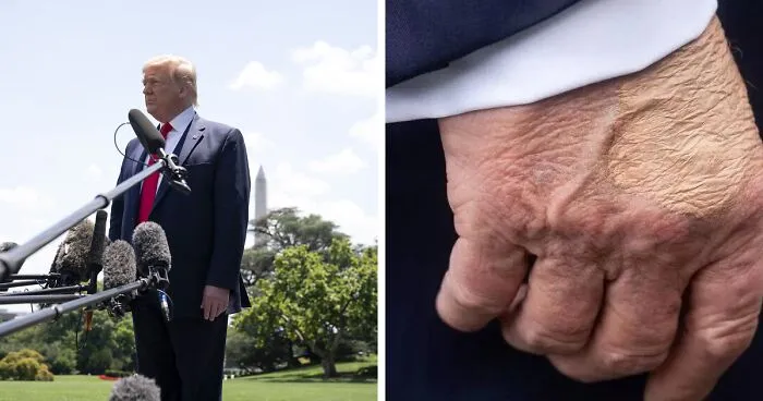 Experts Reveal What Bizarre Marks On Trump’s Body Could Actually Be