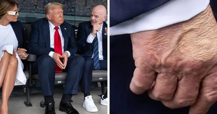 Doctors Diagnose Trump With Chronic Venous Insufficiency—What It Means For His Health