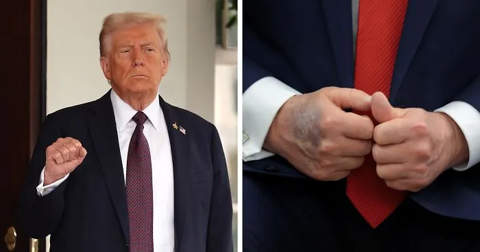 Trump, 79, Confesses At Last He’s Using Compression Socks And Makeup To Mask His Health Issues